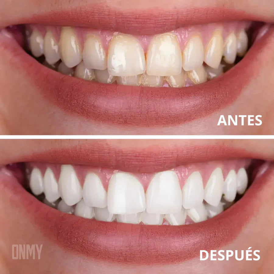 SmileKit® Blanqueador Dental: ¡Blanquea tus Dientes en 30 SEGUNDOS! 💜✨